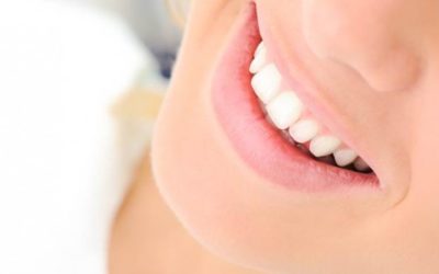 ankara diş beyazlatma