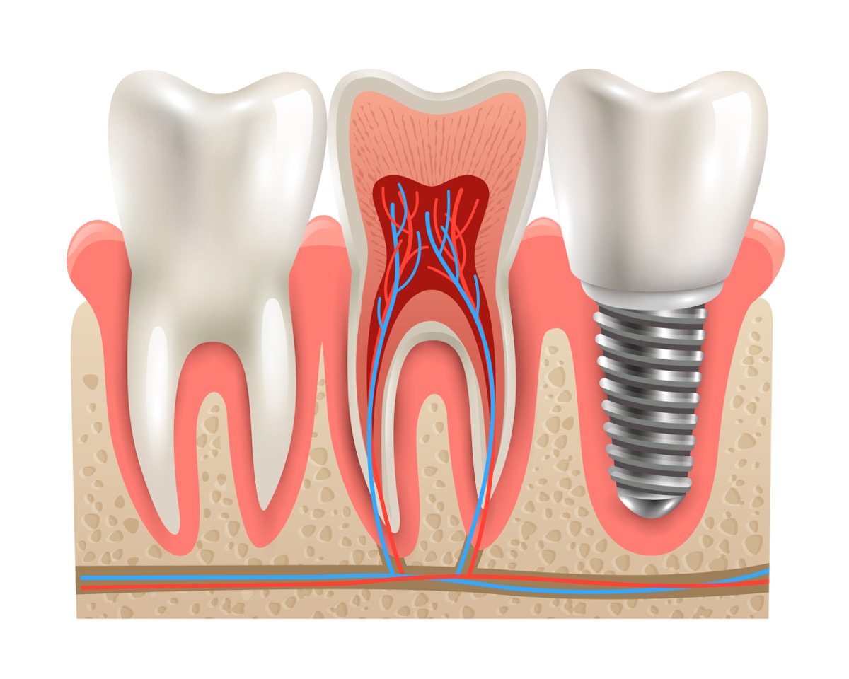 Ankara implant fiyatları - diş ve implant anatomisi kesit görünümü, titanyum vida kemik içinde