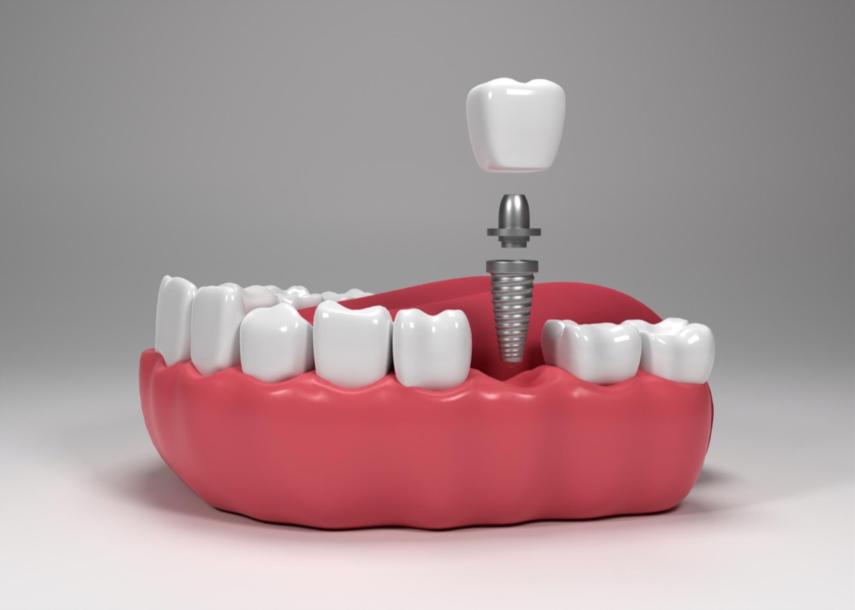 Ankara implant tedavisi - çene modeli üzerinde implant vida abutment ve kuron yerleştirme aşaması