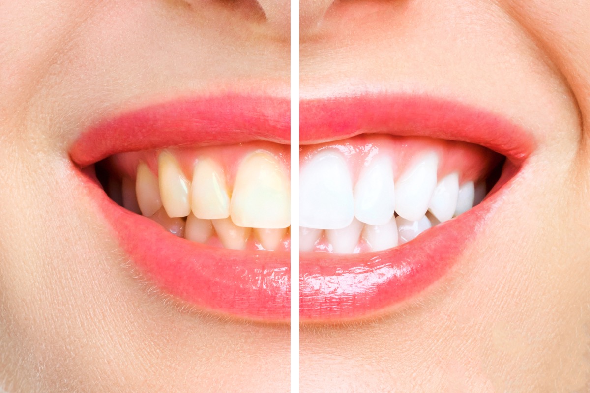 Diş beyazlatma öncesi ve sonrası | Ankara Yenimahalle profesyonel bleaching