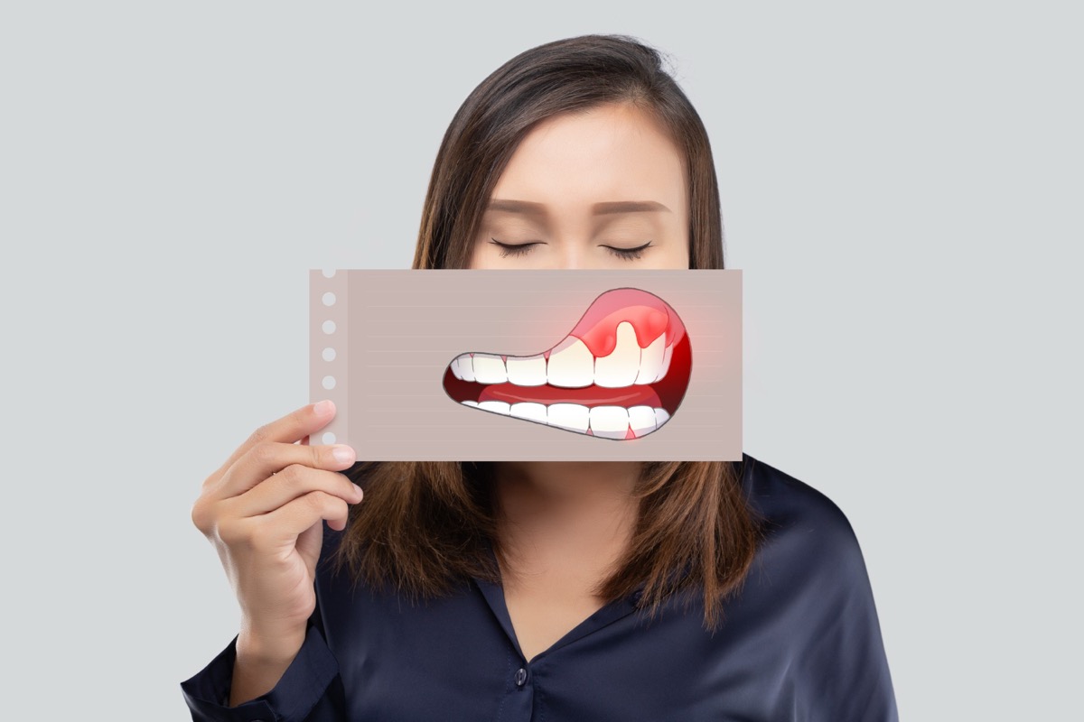Diş eti hastalığı belirtileri | Ankara periodontoloji kliniği