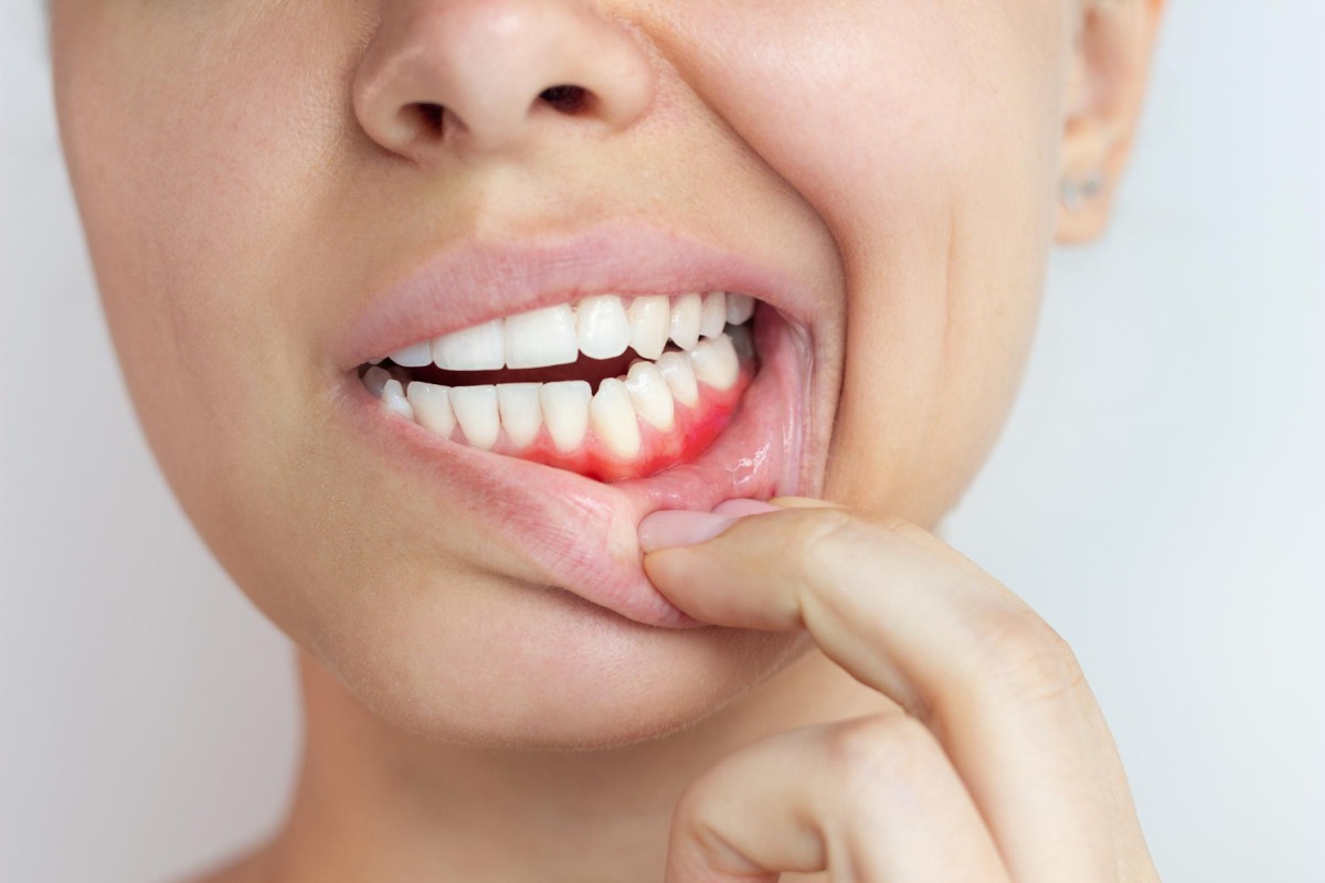 Diş eti iltihabı belirtileri | Ankara periodontoloji Dt. Meryem Ülkü Göçmenoğlu