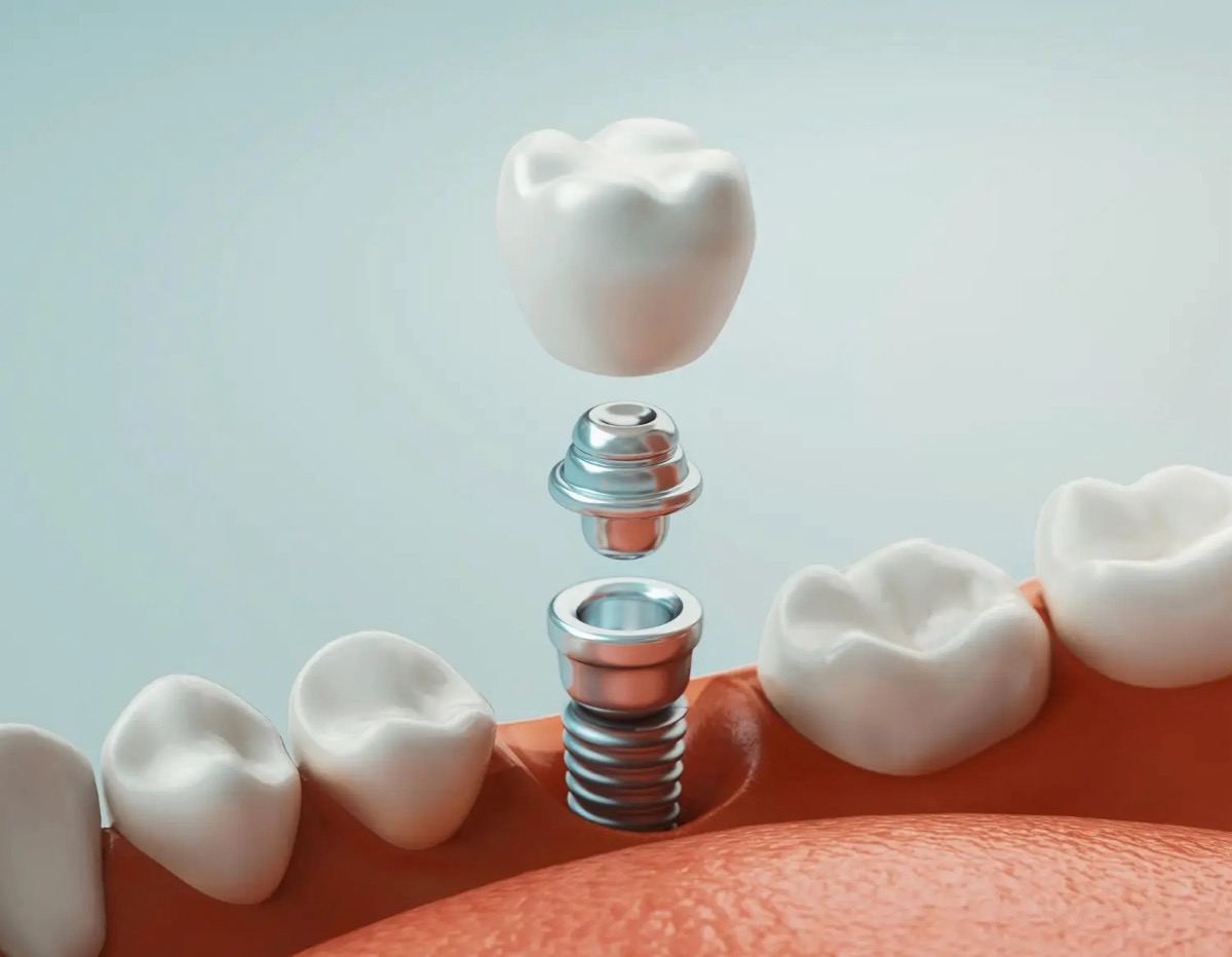 Ankara Demetevler implant tedavisi | Dt. Meryem Ülkü Göçmenoğlu Diş Kliniği